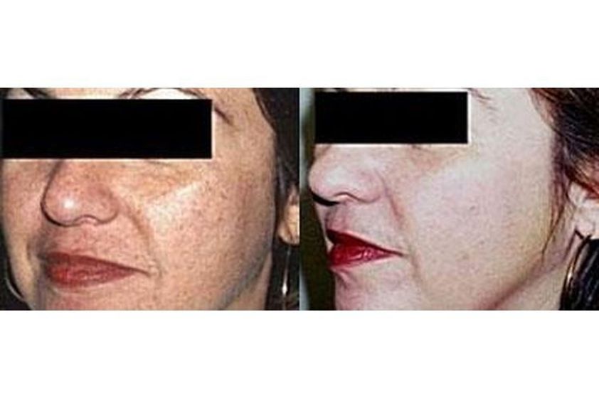 Laserowe zabiegi dermatologii estetycznej przed i po - 691257