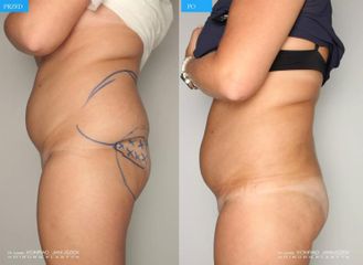 Lipotransfer do pośladków: przed i po