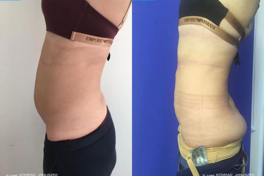 Liposukcja laserowa przed i po - 659733