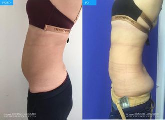 Liposukcja laserowa: przed i po