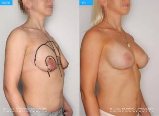 Podniesienie piersi i powiększenie implantami: przed i po