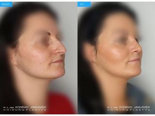 Operacja plastyczna nosa przed i po