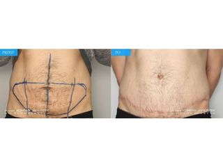 Abdominoplastyka męska - przed i po
