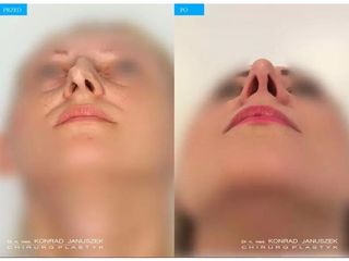 Korekcja nosa - przed i po