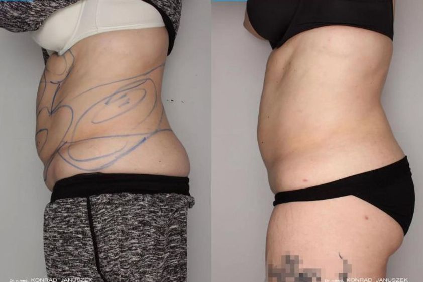 Liposukcja laserowa przed i po - 685984