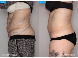 Liposukcja SlimLipo - przed i po