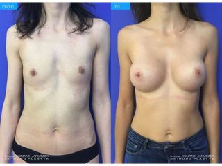 Powiększanie biustu implantami - przed i po
