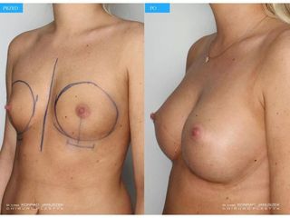 Powiększanie  biustu implantami - przed i po