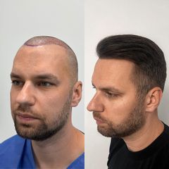 FullFace Clinic Przeszczep włosów DHI po 9 miesiącach
