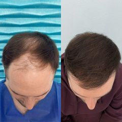 FullFace Clinic Przeszczep wlosow DHI direct 9 miesiecy warszawa