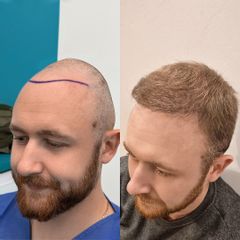 FullFace Clinic przeszczep-wlosow-dhi-direct-9-miesiecy-warszawa