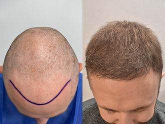 Przeszczep włosów przed i po - 878075