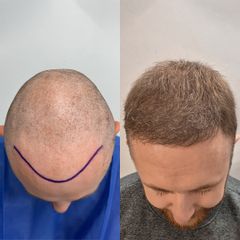 FullFace Clinic Przeszczep wlosow DHI po 9 miesiacach