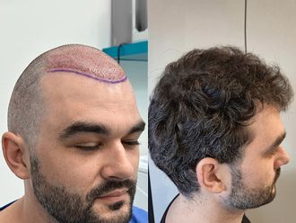 Przeszczep włosów przed i po - 878076