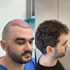 FullFace Clinic Przeszczep wlosow DHI po 9 miesiacach