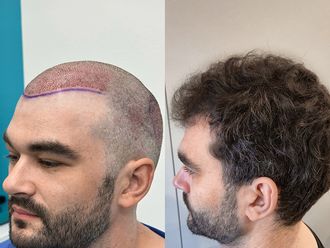 Przeszczep włosów przed i po - 878077
