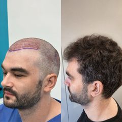 FullFace Clinic Przeszczep wlosow DHI po 9 miesiacach