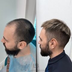 FullFace Clinic Przeszczep wlosow DHI po 9 miesiacach