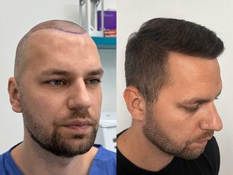 Przeszczep włosów przed i po - 878079