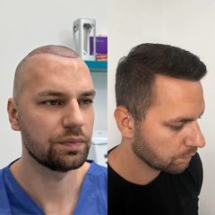 FullFace Clinic Przeszczep włosów DHI po 9 miesiącach
