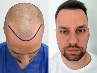 Przeszczep włosów przed i po - 878080