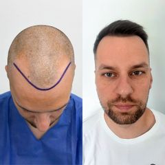 FullFace Clinic 9 miesięcy po przeszczepie