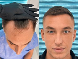 Przeszczep włosów przed i po - 878081