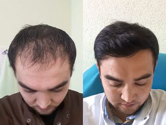 Przeszczep włosów przed i po - 878082