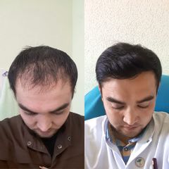 FullFace Clinic DHI Direct – efekt po 9 miesiącach