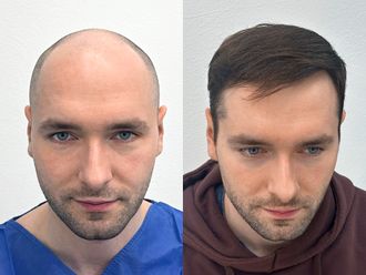 Przeszczep włosów przed i po - 878085