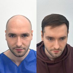 FullFace Clinic Przeszczep wlosow