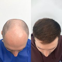 FullFace Clinic – Trapianto di capelli DHI dopo 9 mesi