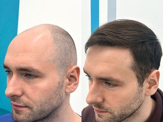 Przeszczep włosów przed i po - 878087