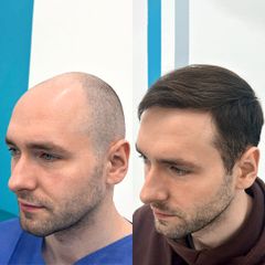 FullFace Clinic – Trapianto di capelli DHI dopo 9 mesi