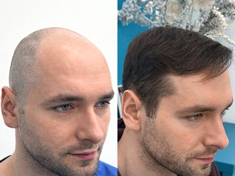 Przeszczep włosów przed i po - 878088