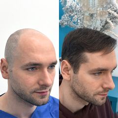 FullFace Clinic – Trapianto di capelli DHI dopo 9 mesi