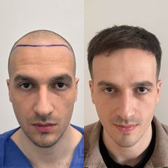 FullFace Clinic - Przeszczep włosów