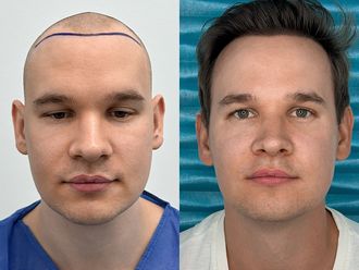 Przeszczep włosów przed i po - 878593