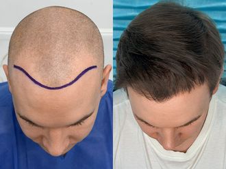 Przeszczep włosów przed i po - 878594