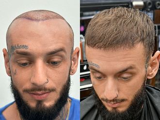 Przeszczep włosów przed i po - 878595