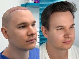 Przeszczep włosów przed i po - 878618