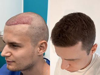 Przeszczep włosów przed i po - 878619