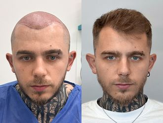 Przeszczep włosów przed i po - 878620