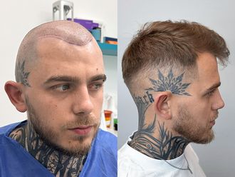 Przeszczep włosów przed i po - 878621