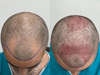 Przeszczep włosów przed i po - 878622