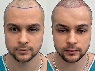 Przeszczep włosów przed i po - 878623