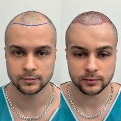 Przeszczep włosów w FullFace Clinic