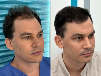 Przeszczep włosów przed i po - 878668