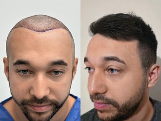 Przeszczep włosów przed i po - 878679