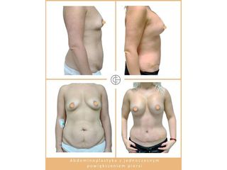 Abdominoplastyka - przed i po